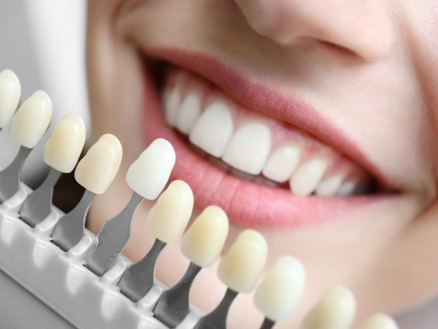 Paciente em avaliação para clareamento dentário em Brasília