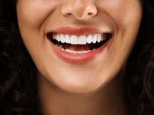 Comparação de dentes representando dúvidas sobre o preço da lente de contato dental em Brasília