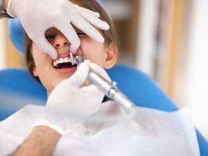 Procedimento de raspagem periodontal e diferença para limpeza dental comum